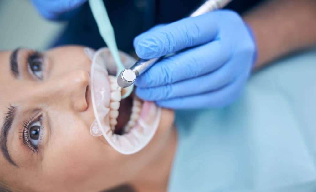 Bonding Diş Uygulaması