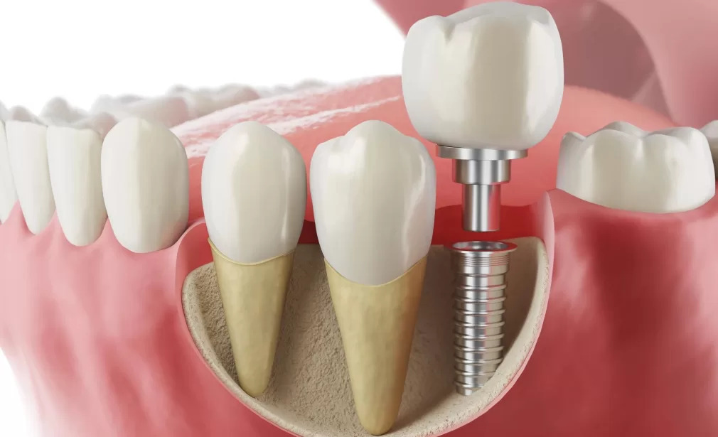 İmplant Tedavisi