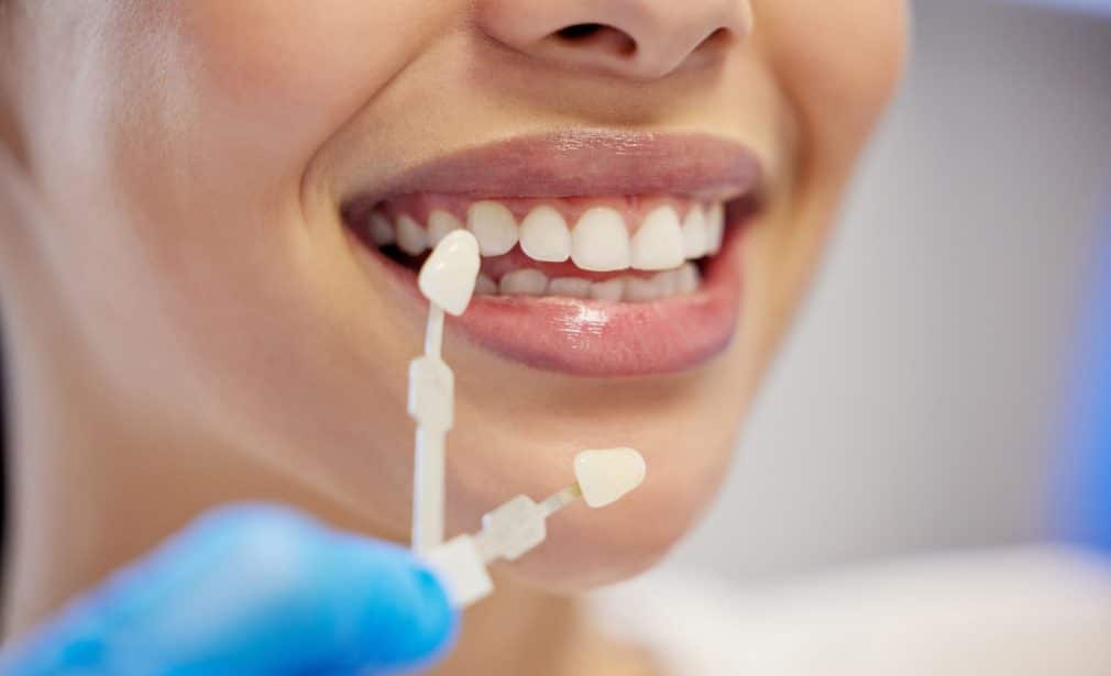 Lamina (Laminate Veneer)